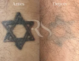 Renata Santos | Remoção a laser de tatuagem e micropigmentação