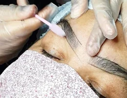 Renata Santos | Remoção a laser de tatuagem e micropigmentação